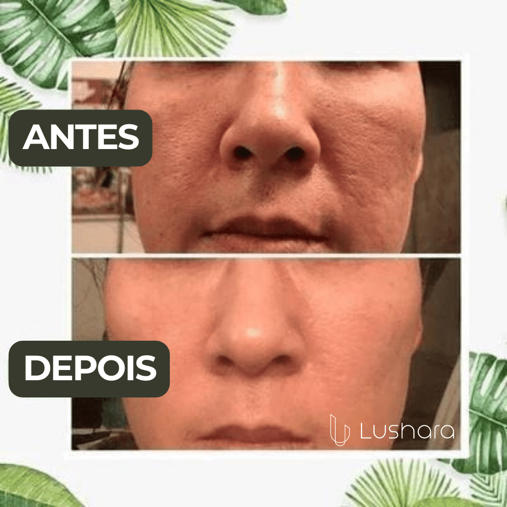 GreenMask® - Máscara Removedora para Cravos, Acne e Poros